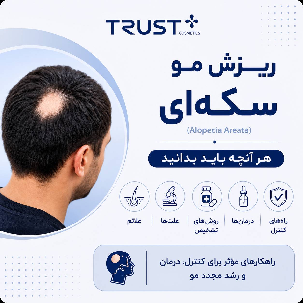 ریزش مو سکه‌ای (Alopecia Areate) و راهکارهای جلوگیری و رویش مجدد